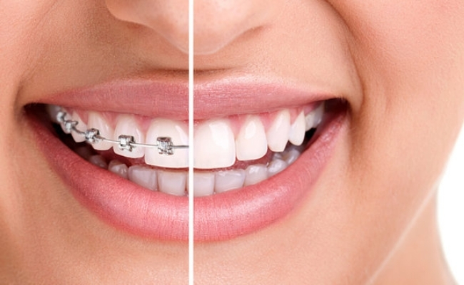 Braces-metal-ceramic-32-1.jpg